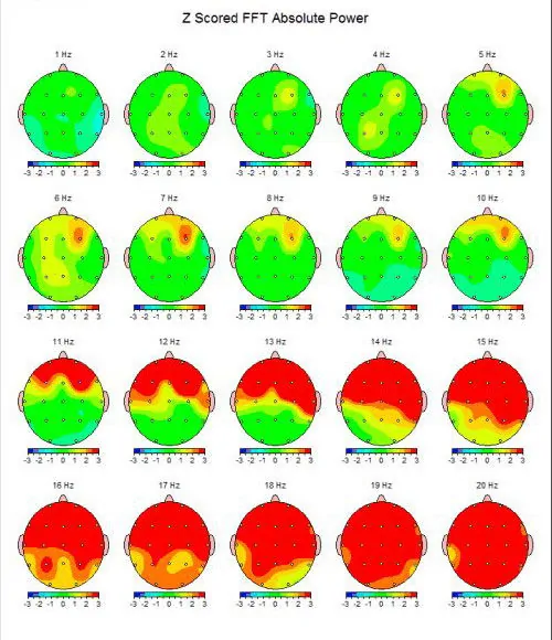 QEEG-uitslag: Z-scored FFT absolute power per frequentie van 1 tot 20 Hz.